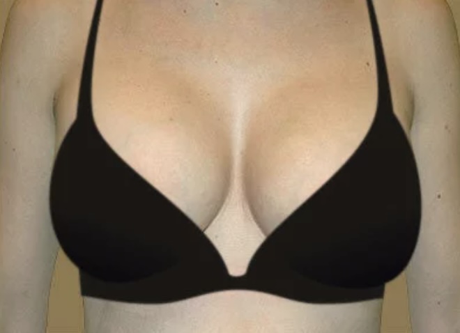 After Procedure