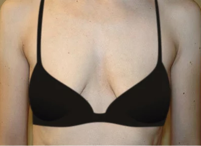 Before Procedure