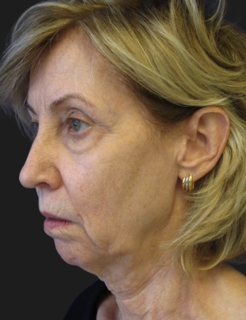 Before Procedure