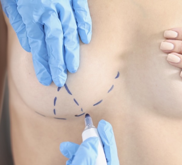 Breast Surgery