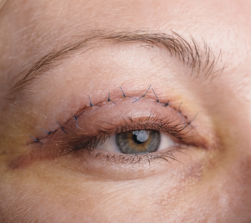 Eyelid Surgery