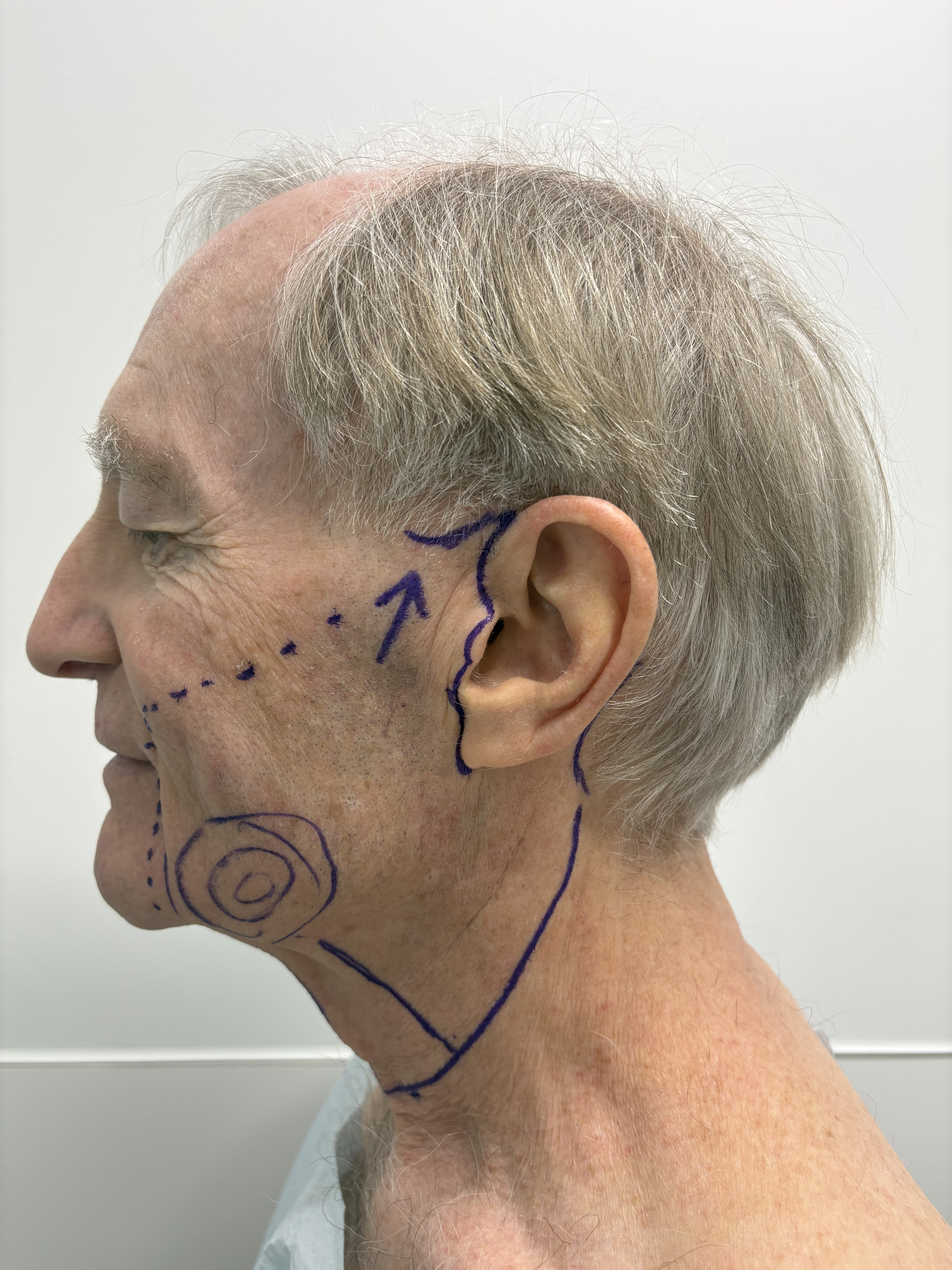 Face Surgery